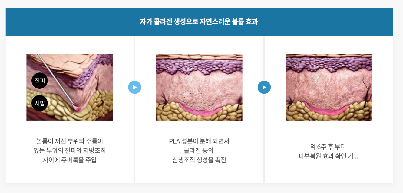 자가 콜라겐 생성으로 자연스러운 볼륨 효과